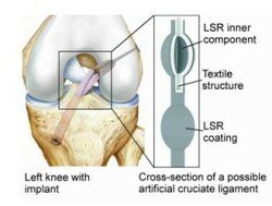 Composite structure of a biomimeticcruciate ligament replacement